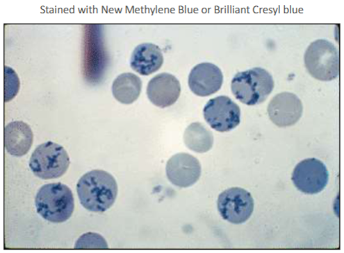 <p>Also known as polychromatophilic erythrocyte or reticulocyte</p><p>Reported as polychromasia on a CBC (graded as a 0 to 3+)</p><p>Cell size is 7-10 micrometers</p><p>No nucleus</p><p>Cytoplasm is bluish color due to the presence of RNA<br>New methylene blue or brilliant cresyl blue stains the RNA and organelles to confirm these cells as reticulocytes</p><p>Reference range in peripheral blood for reticulocytes is 2.5%-6.0% in newborns and 0.5%-2.0% in adults</p>