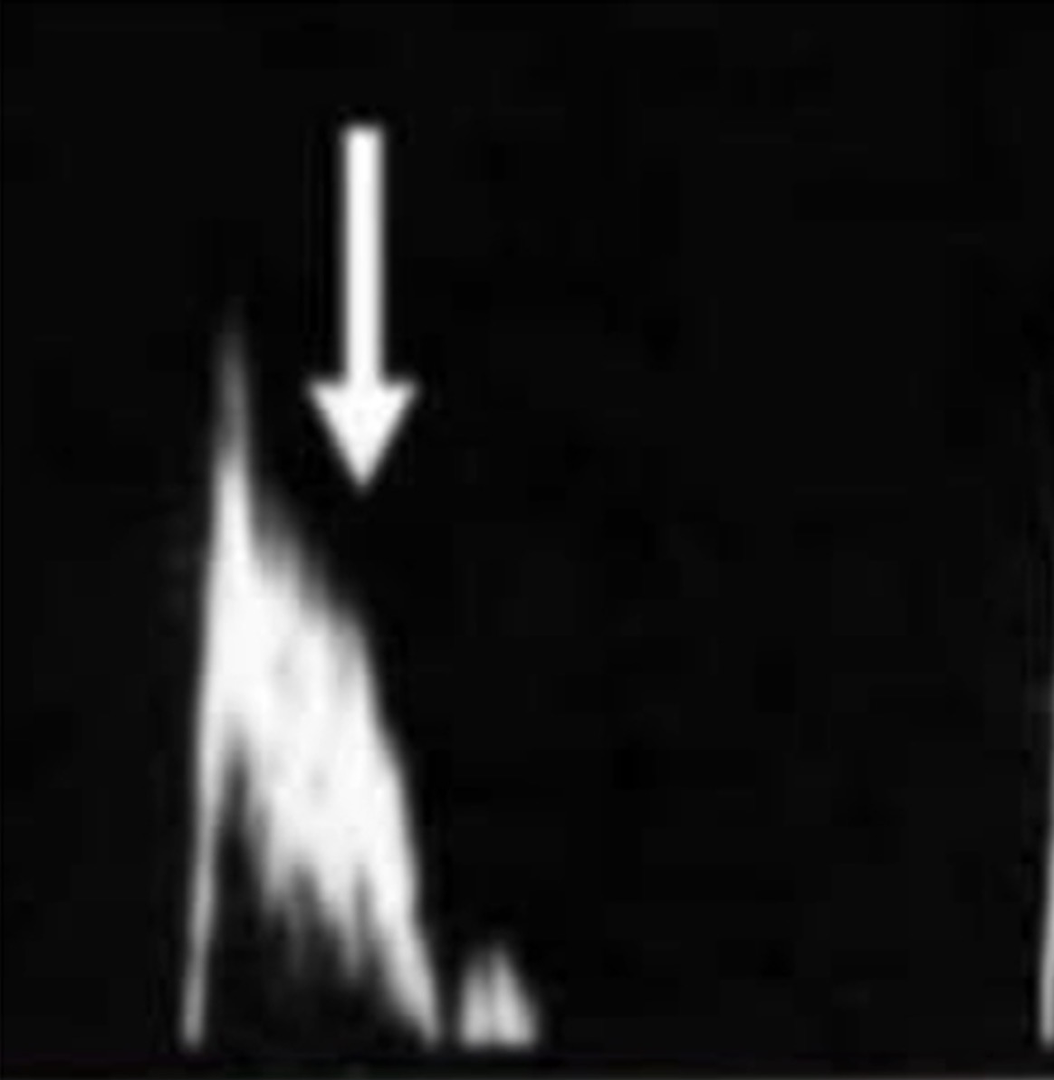 <p>Looking at this waveform, are you before at or after a stenosis?</p>