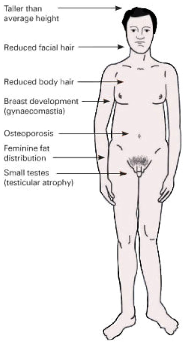 <p>- Its characteristics are Male; tall stature; tendency toward low IQ, especially verbal</p><p>-Its incidence are 1 in 1,000 male births</p><p>- No special treatment</p>