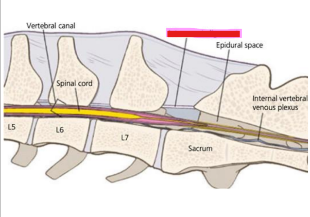 <p>Q: According to the image, the structure highlighted in red is the ......</p><p>A. Epidural space</p><p>B. Vertebral canal</p><p>C. Interarcuate ligament</p><p>D. Internal vertebral venous plexus</p>