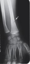 <p>Only one side of the shaft breaks while the other bends; common in children.</p>