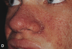 <p>angiofibromas of the skin presenting as a reddish brown papular rash in 75% of patients having tuberous sclerosis</p>