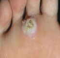 <p>Verruca Plantaris </p>