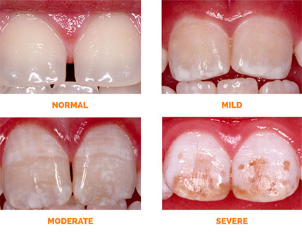 <p>mottling of the teeth (from dental fluorosis condition)</p>