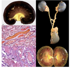 <p>Which disease affecting renal tubules is shown in this image and occurs in sheep?</p>