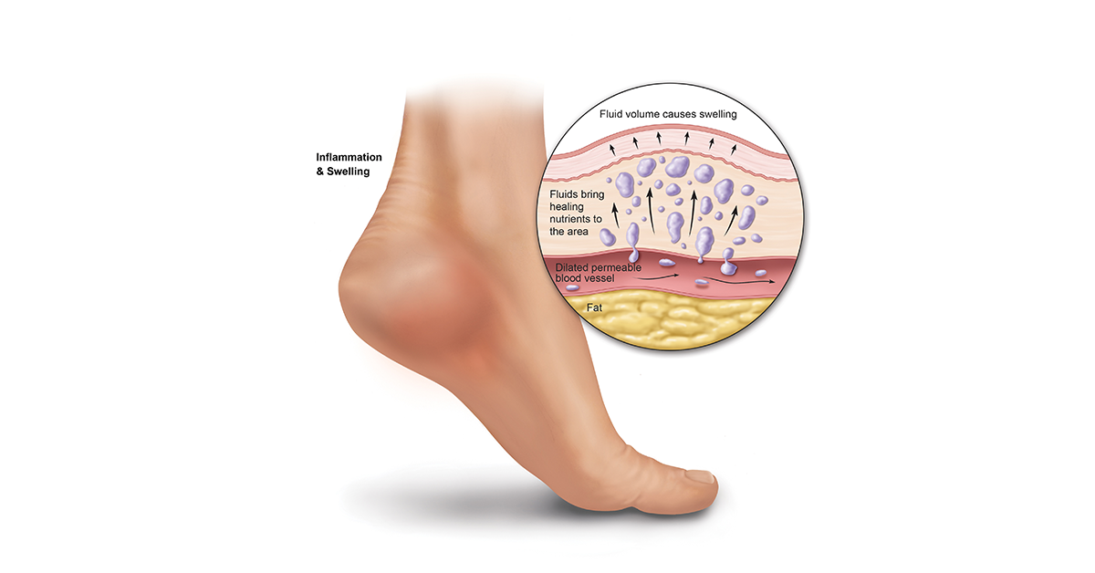 <p>Protein-rich fluid in extracellular tissue (exudate), causes edema/swelling. Blood becomes more viscous and circulation slows down</p>