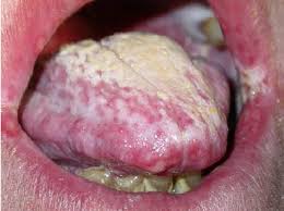 <p>What lesion is this?</p>