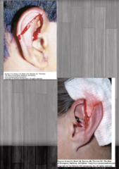 <p>- Provide copious irrigation</p><p>- Debridement as necessary</p><p>- Closure to cover exposed cartilage and preserve cosmetic appearance (often plastic surg)</p><p>Avulsion, lacerations extending into ear canal, lacerations with middle or inner ear injury, or evidence of basilar skull fractures should be seen by plastic surgery and/or neurosurgery</p>