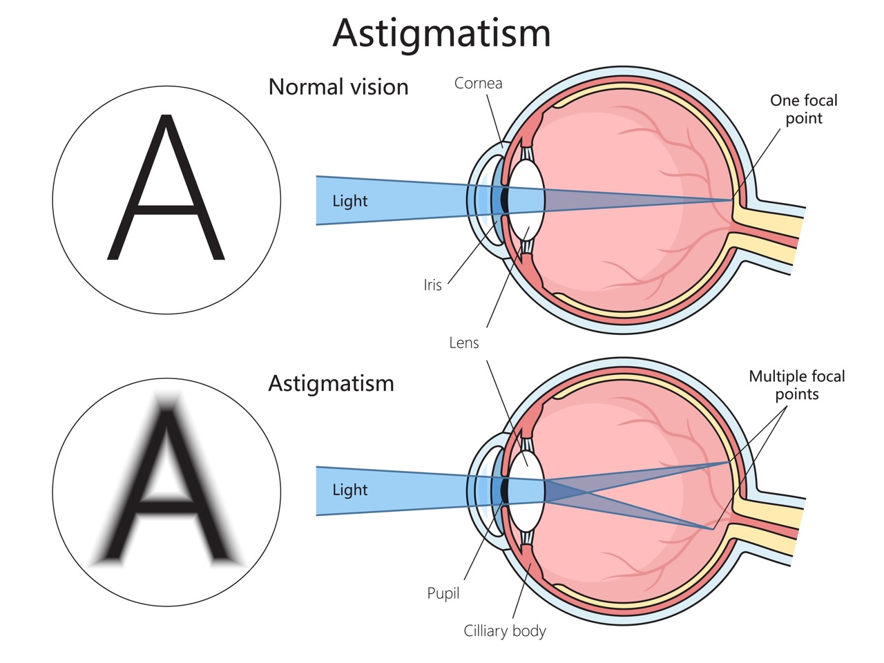 <p>PP: refractive lens error→problem with how eye focuses light<br>not a dx</p><p>E: misshapen cornea<br>misshapen lens</p>