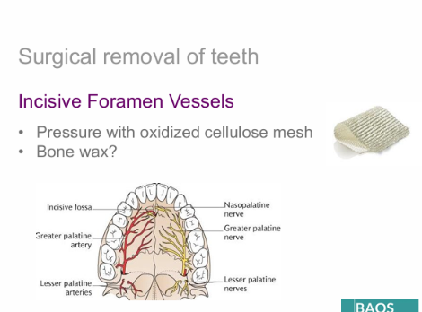 <ul><li><p>Incisive foramen vessels</p></li><li><p>Pressure with oxidized cellulose mesh</p></li><li><p>Bone wax - must be removed as not resorbable</p></li></ul><p></p>