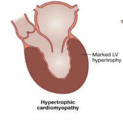 <p>What is <em>Hypertrophic Cardiomyopathy (HCM)</em>? </p>