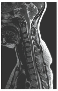 <p><strong>Multiple sclerosis (MS)</strong><span> is a </span><strong>demyelinating disease</strong><span> that can be found in the </span><strong>brain or spinal cord</strong><span>. It is represented on imaging by areas of </span><strong>inflammatory plaques</strong></p><p></p><p><strong>MRI Appearance</strong></p><ul><li><p><span style="font-family: inherit; line-height: inherit; font-size: inherit;">•</span></p><p><strong>MS plaques will have high signal on T2-weighted images</strong></p></li><li><p><span style="font-family: inherit; line-height: inherit; font-size: inherit;">•</span></p><p><strong>Active plaques enhance on post-contrast (T1-weighted) images</strong></p></li><li><p><span style="font-family: inherit; line-height: inherit; font-size: inherit;">•</span></p><p><strong>T2 FLAIR imaging is the best sequence for detecting MS plaques</strong></p></li></ul><p></p>