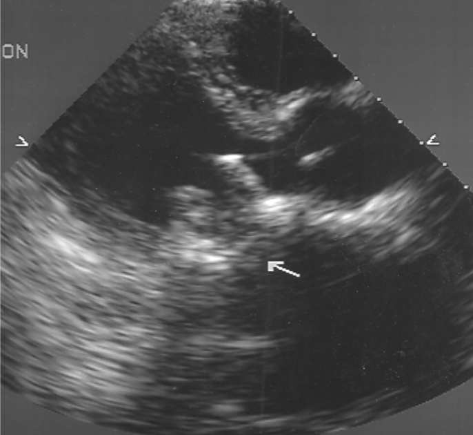 <ul><li><p>Bioprosthetic</p></li><li><p>a pig’s AoV is placed on stents and attached to a sewing ring</p></li><li><p>most commonly used for MV replacement</p><ul><li><p>will have 3 leaflets</p></li></ul></li><li><p>Manufacturers:</p><ul><li><p>Hancock</p></li><li><p>Carpentier-Edwards</p></li><li><p>Intact</p></li></ul></li></ul><p></p>