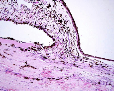 <p>Most common</p><ul><li><p>Can be congenital</p></li><li><p>Caused by goniodysgenesis</p></li></ul><img src="https://assets.knowt.com/user-attachments/4794e88e-27c6-4074-9129-328c5e494c0e.png" data-width="100%" data-align="center"><p></p>