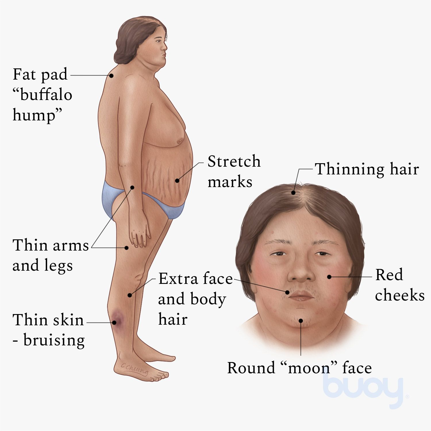 <ul><li><p><span style="background-color: transparent; font-family: "Times New Roman", serif;">Weight gain</span></p></li><li><p><span style="background-color: transparent; font-family: "Times New Roman", serif;">Thin arms and legs</span></p></li><li><p><span style="background-color: transparent; font-family: "Times New Roman", serif;">Round face</span></p></li><li><p><span style="background-color: transparent; font-family: "Times New Roman", serif;">Fatty hump</span></p></li></ul><p></p>