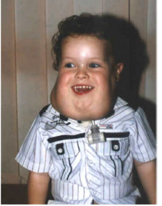 <ul><li><p>found in the neck or maxilla of children up to 15 cm in size</p></li><li><p>75% occur in head and neck</p></li></ul><p></p>