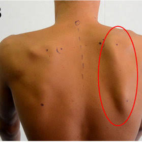 <p>medial border/winged scapula</p>