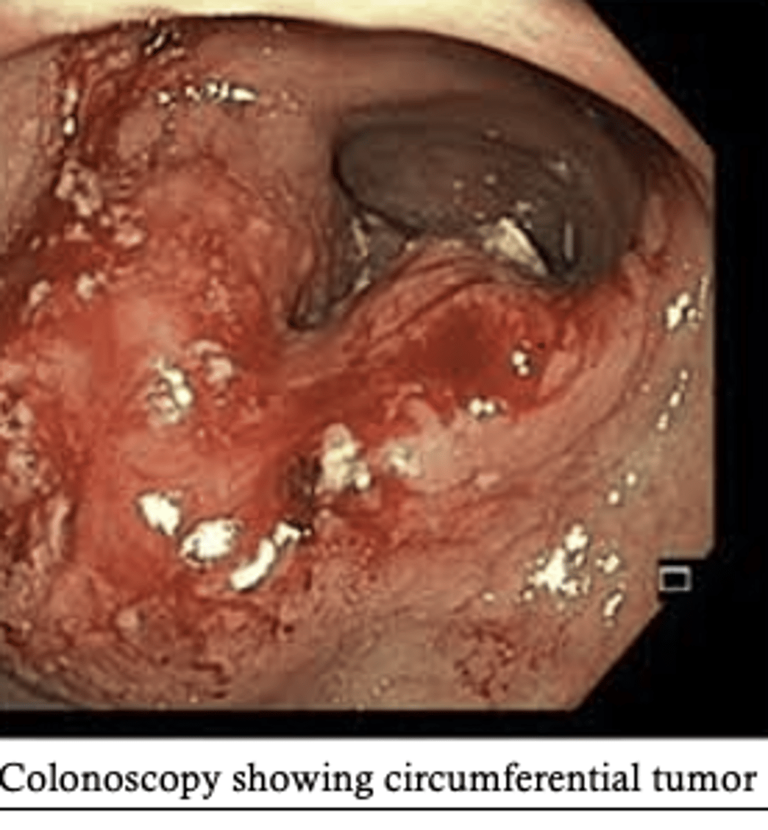 <p>involving all surfaces of a circular structure like the bowel lumen. used most often when referring to bowel tumors and the growth pattern tumors within a lumen</p>