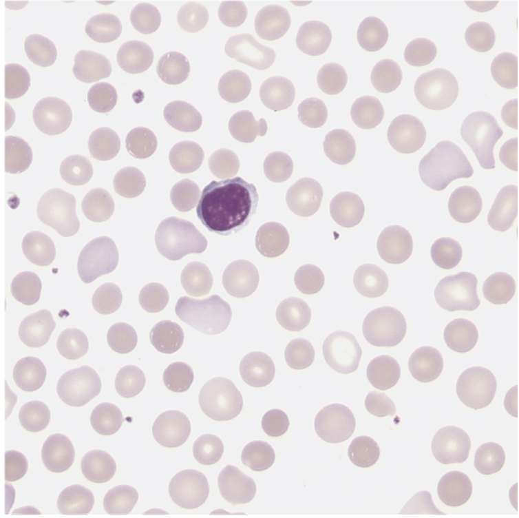 <p><span>A 45-year-old man sought medical attention for the onset of chest pain. Physical examination revealed slight jaundice and splenomegaly. The medical history included gallstones, and there was a family history of anemia. A complete blood count (CBC) yielded the following results:</span></p><table style="min-width: 50px;"><colgroup><col style="min-width: 25px;"><col style="min-width: 25px;"></colgroup><tbody><tr><td colspan="1" rowspan="1" style="width: 112pt;"><p style="text-align: left;"><span><strong>WBCs (×109/L)</strong></span></p></td><td colspan="1" rowspan="1" style="width: 108pt;"><p style="text-align: left;"><span><strong>13.4</strong></span></p></td></tr><tr><td colspan="1" rowspan="1" style="width: 112pt;"><p style="text-align: left;"><span><strong>RBCs (×1012/L)</strong></span></p></td><td colspan="1" rowspan="1" style="width: 108pt;"><p style="text-align: left;"><span>4.20</span></p></td></tr><tr><td colspan="1" rowspan="1" style="width: 112pt;"><p style="text-align: left;"><span><strong>HGB (g/dL)</strong></span></p></td><td colspan="1" rowspan="1" style="width: 108pt;"><p style="text-align: left;"><span>11.9</span></p></td></tr><tr><td colspan="1" rowspan="1" style="width: 112pt;"><p style="text-align: left;"><span><strong>HCT (%)</strong></span></p></td><td colspan="1" rowspan="1" style="width: 108pt;"><p style="text-align: left;"><span>32.4</span></p></td></tr><tr><td colspan="1" rowspan="1" style="width: 112pt;"><p style="text-align: left;"><span><strong>MCV (fL)</strong></span></p></td><td colspan="1" rowspan="1" style="width: 108pt;"><p style="text-align: left;"><span>77.1</span></p></td></tr><tr><td colspan="1" rowspan="1" style="width: 112pt;"><p style="text-align: left;"><span><strong>MCH (pg)</strong></span></p></td><td colspan="1" rowspan="1" style="width: 108pt;"><p style="text-align: left;"><span>28.3</span></p></td></tr><tr><td colspan="1" rowspan="1" style="width: 112pt;"><p style="text-align: left;"><span><strong>MCHC (g/dL)</strong></span></p></td><td colspan="1" rowspan="1" style="width: 108pt;"><p style="text-align: left;"><span>36.7</span></p></td></tr><tr><td colspan="1" rowspan="1" style="width: 112pt;"><p style="text-align: left;"><span><strong>RDW (%)</strong></span></p></td><td colspan="1" rowspan="1" style="width: 108pt;"><p style="text-align: left;"><span>22.9</span></p></td></tr><tr><td colspan="1" rowspan="1" style="width: 112pt;"><p style="text-align: left;"><span><strong>Platelets (×109/L)</strong></span></p></td><td colspan="1" rowspan="1" style="width: 108pt;"><p style="text-align: left;"><span>290</span></p></td></tr></tbody></table><p><strong><em>What is the most likely diagnosis?</em></strong></p>