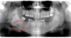 <p>What is the location of this lesion?</p>