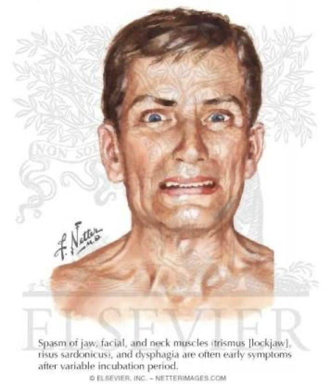 <p>It is a delayed one with abnormal, irregular movements of the muscle of the head, limb & trunk</p><p>Characterized by chewing, sucking, grimacing and perioral movements</p>