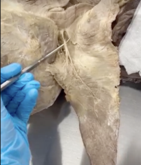 <p>Name the structure</p><p>- on top of spinal accessory nerve</p>