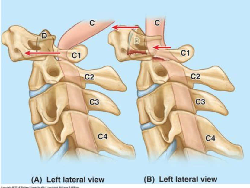<p>Transverse ligament tears - atlanto-axial instability</p>