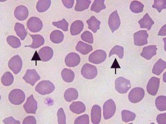 <p>hemolytic process</p>