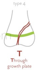 <p>vertical splitting of epiphysis, extending through physis and metaphysis</p>
