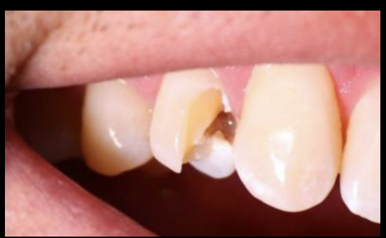 <p>disruption of the enamel and/or dentin and/or cementum that is assumed to be of greater depth than a crack</p><ul><li><p>of unknown depth or extension</p></li><li><p>visible or not</p></li><li><p>is visible clinically or radiographically </p></li><li><p>separated or unseparated segments </p></li></ul><p></p>