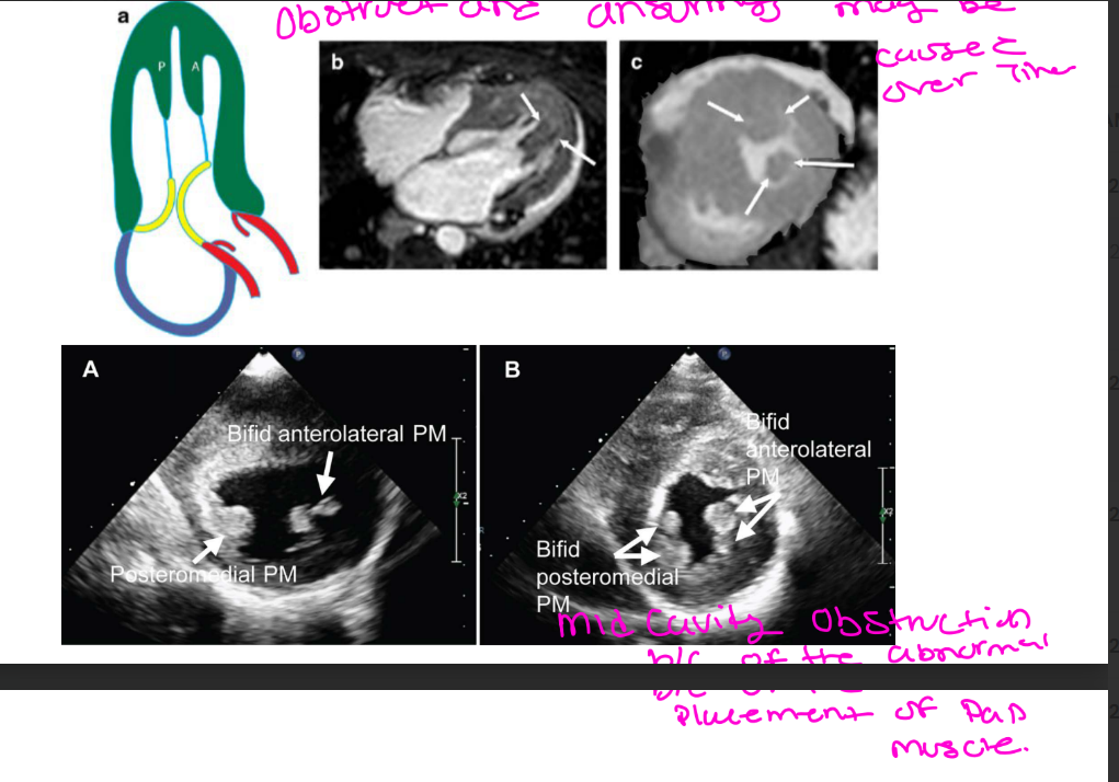 <ol><li><p>Hypertrophied papillary muscles</p></li><li><p>Apically/anteriorly displaced papillary muscles</p></li><li><p>Bifid papillary muscles</p></li></ol><p><strong>Simple reminder:</strong><br>Papillary muscle abnormalities can contribute to abnormal mitral valve motion and obstruction.</p><p>A bifid papillary muscle is a papillary muscle that has a divided or double-headed appearance.</p>
