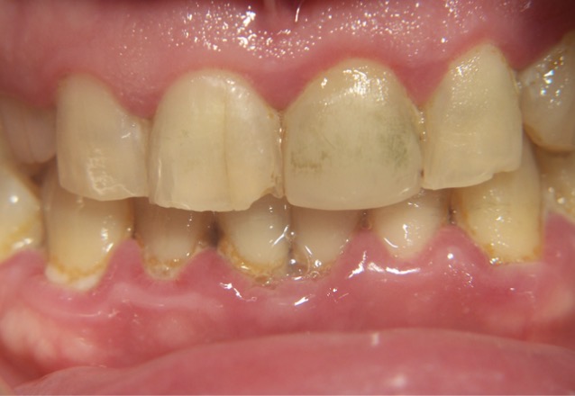 <p>Why is green stain difficult to remove?</p>