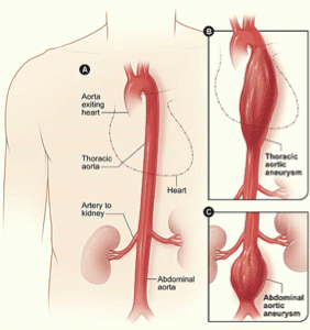 <p>remember this picture for thoracic vs abdominal aortic aneurysm</p>