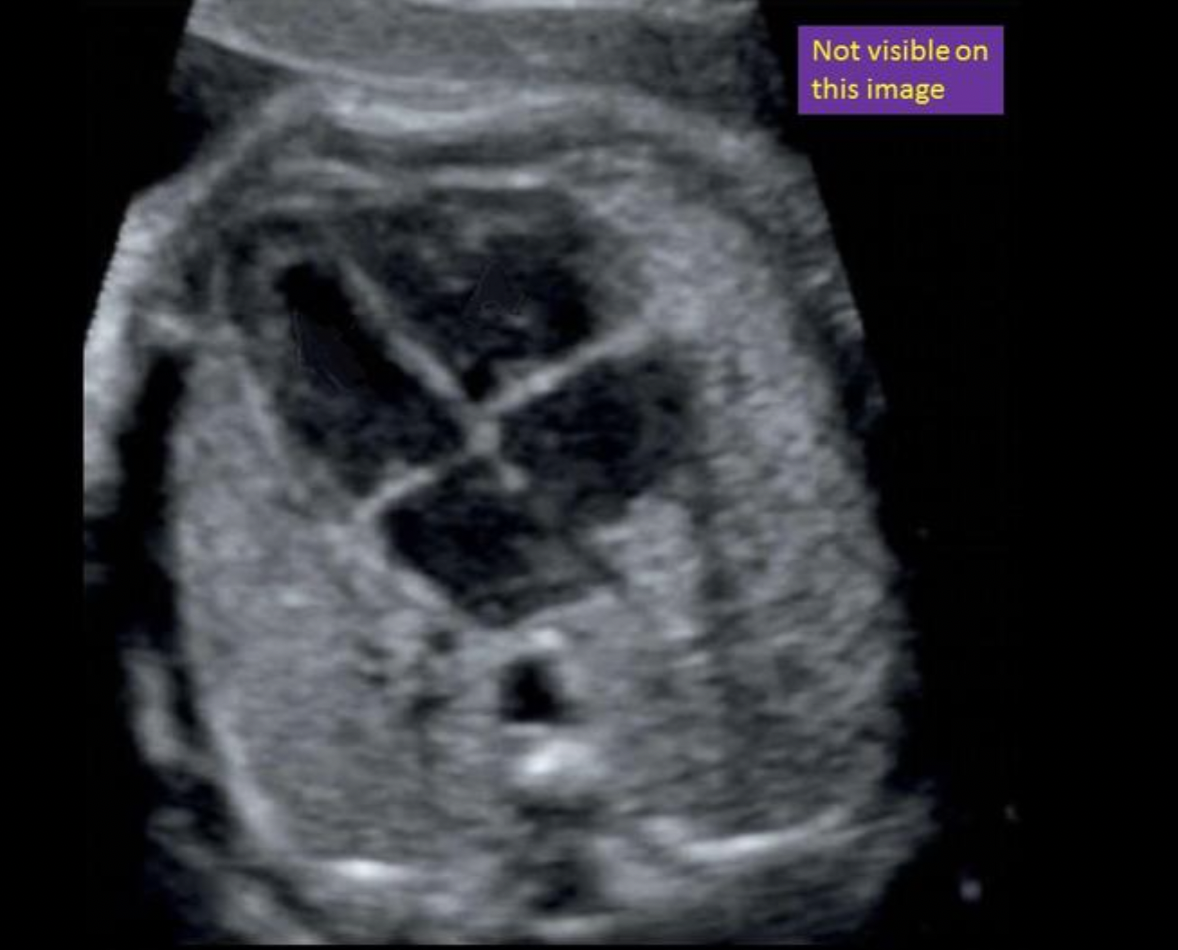 <p>Locate the foramen ovale. The structure may or many not be visible in the image</p>