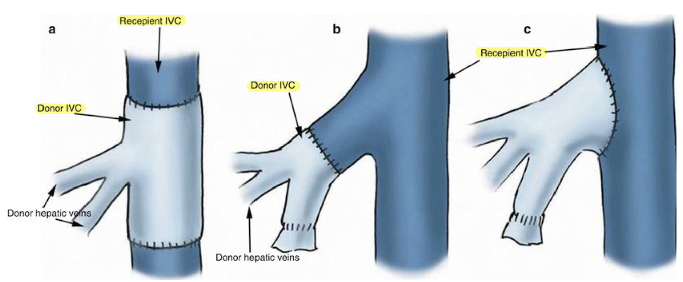 <ul><li><p>donor IVC and recipient IVC are connected using a “<span style="color: yellow;">piggyback</span>” technique </p><ul><li><p>donor IVC sewn end to side or within the recipient IVC)</p></li><li><p>(ANNOTATE: “<span style="color: red;">IVC/IVC anast</span>”)</p></li></ul></li><li><p>end to end portal anastomosis </p></li><li><p>end to end common hepatic artery anastomosis</p></li><li><p>CBD is anastomosed</p></li><li><p>cholecystectomy is done on donor liver</p><ul><li><p>sonographer should image the fossa (follow main lobar fissure—from MPV to the GB neck)</p></li></ul></li><li><p>surgical drains may be placed in right and left subhepatic spaces and secured to the skin with sutures</p></li></ul><p></p>