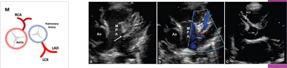 <ol><li><p>left coronary artery arising off the right coronary sinus</p></li><li><p>right coronary artery arising off the left coronary sinus</p></li><li><p><strong>anomalous left coronary artery arising off the pulm artery (ALCAPA) </strong></p></li></ol><p></p>