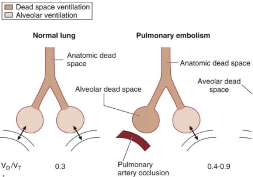 <p>Blood flow obstruction in pulmonary circulation</p><p>No perfusion to ventilated area = Physiological dead space</p><ul><li><p>Normal V, low Q</p></li><li><p>V/Q > 0.80</p></li></ul><p>Increase CO2 retention</p>