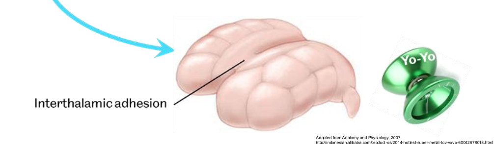 <p>Interthalamic adhesion</p>