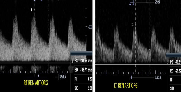 <p>this image is from a RA duplex, what waveform is expected for the right renal parenchymal arteries?</p>