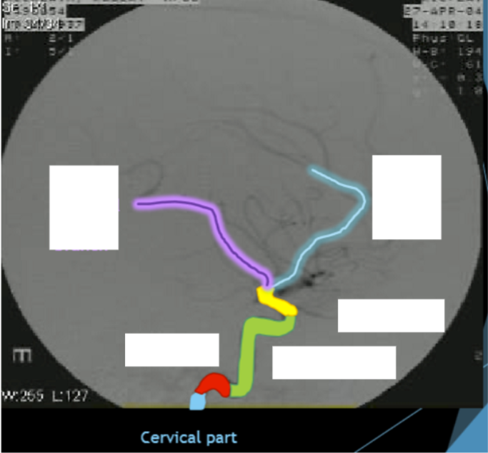 <p>Please label the internal carotid artery (ICA) </p>