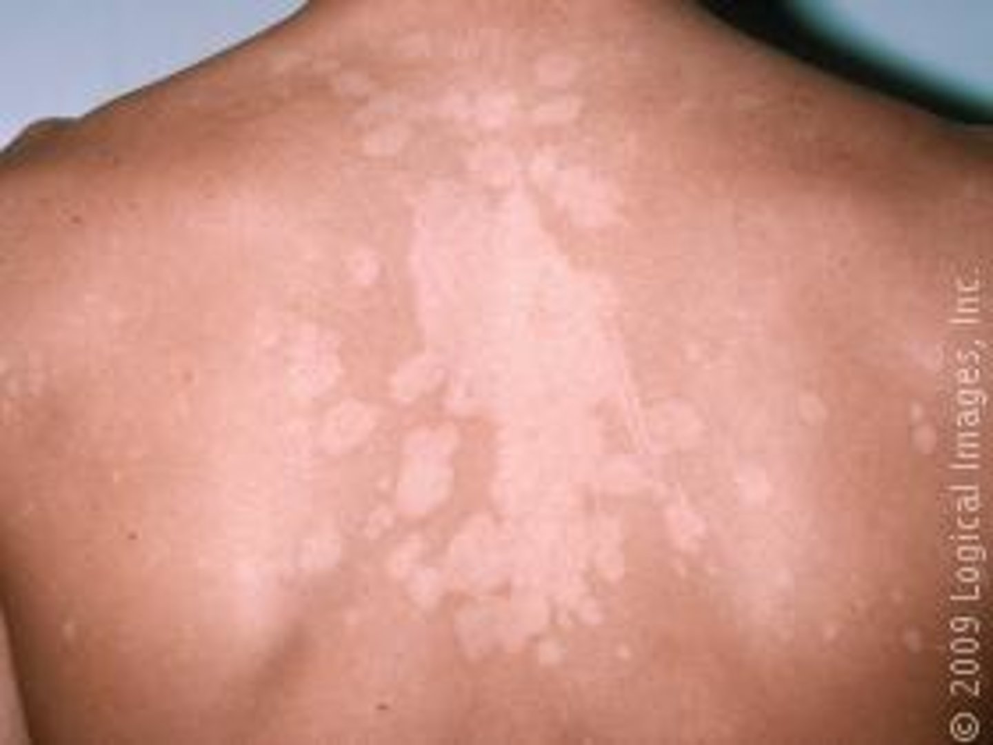 <p>-fungal rash</p><p>-hypo/hyper pigmented or tan round/oval macules</p><p>-causes discolored patches</p>