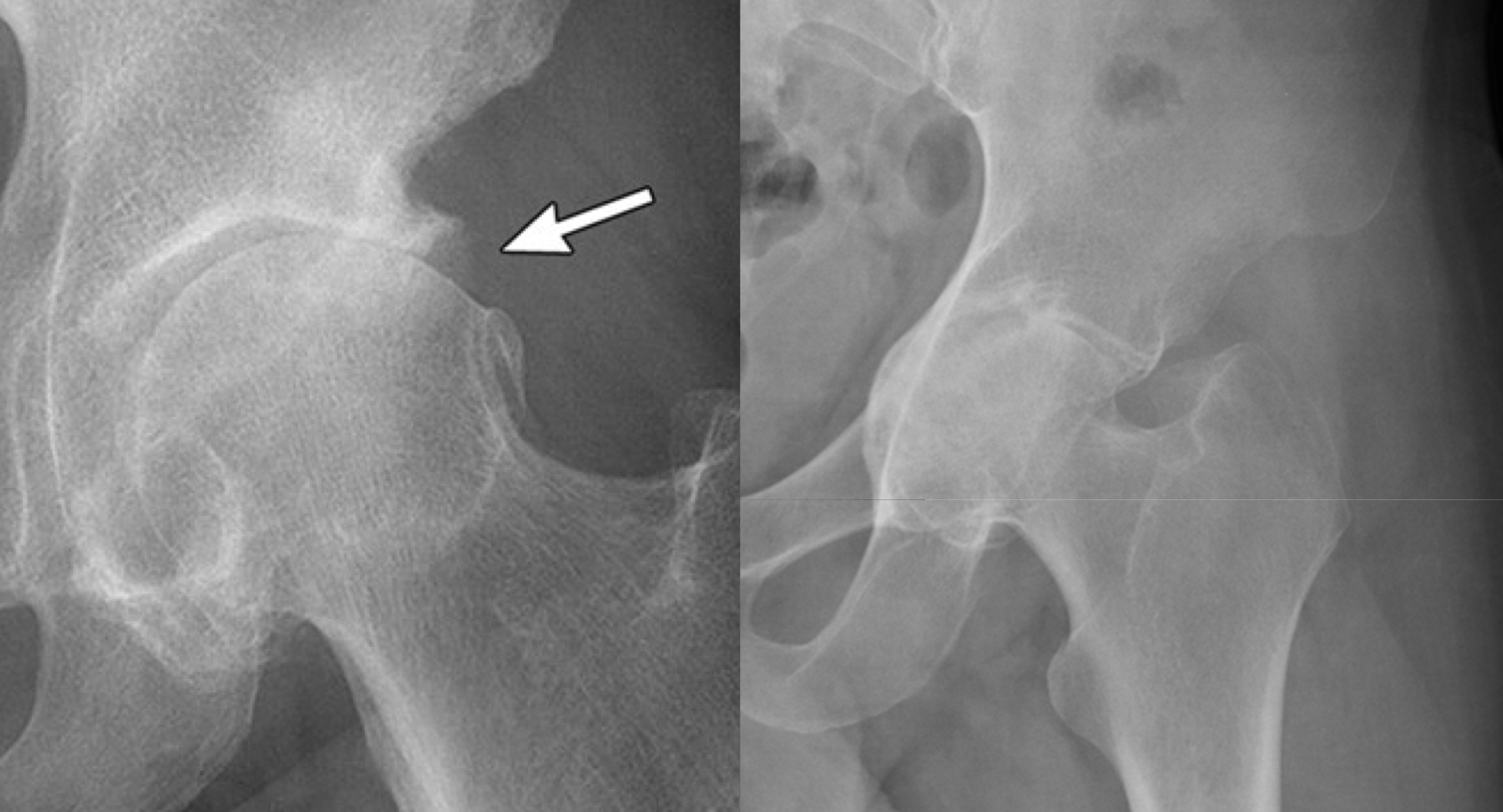 <p>OA or RA (left vs right)</p>