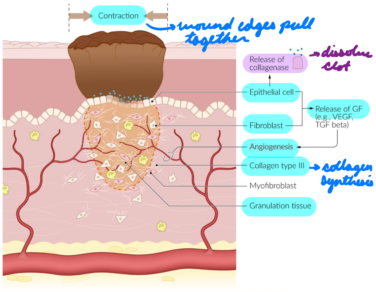 <p>Day 3-7</p><p>Granulation tissue formation</p><ul><li><p>Smooth muscle migration + fibroplasia = Collagen synthesis</p></li><li><p>Fibroblasts + epithelial cells release growth factors = Angiogenesis</p></li><li><p>Wound contraction = Pull wound edges together</p></li></ul><p>Epidermal cells migrate across collagen = Form layer over wound</p><ul><li><p>Secrete collagenase = Dissolve clot</p></li></ul><p></p>