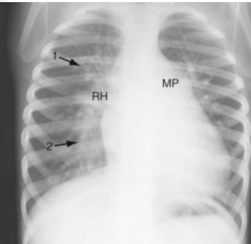 <ul><li><p>Increased pulmonary vascular markings</p></li><li><p>Enlarged left atrium</p></li><li><p>Enlarged left ventricle</p></li><li><p>Enlarged pulmonary artery</p></li></ul><p></p>