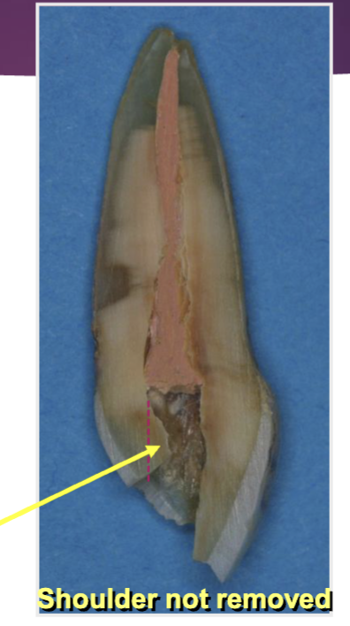 <p>lingual shoulder </p>