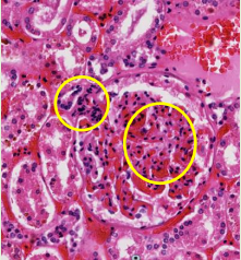 <p><strong>Extraglomerular mesangial cells (not in pic):</strong></p><p><span style="color: purple;">(Juxtaglomerular apparatus)</span></p><p></p><p><strong>Intraglomerular mesangial cells (MC in pic) for:</strong></p><p><span style="color: purple;">Phagocytosis</span></p><p><span style="color: purple;">Vasoconstriction</span></p><p></p><p>Histologically, there are 2 to 3 mesangial cell nuclei beneath each capillary loop</p><p></p><p>Collectively, the mesangial cells and the glomerular extracellular matrix that they produce constitute the <span style="color: purple;">mesangium</span></p><p></p><p>they’re basically<span style="color: purple;"> immune cells</span></p><p>specialized, smooth muscle-like cells in the kidneys that support the structure of the glomerulus and help regulate blood filtration.</p>