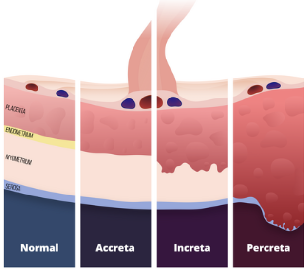 <ul><li><p>placenta accreta - slight penetration of myometrium</p></li><li><p>placenta increta - deep penetration of myometrium</p></li><li><p>placenta percreta - perforation of myometrium and uterine serosa, may involve adjacent organs</p></li><li><p>r/o PPH and previa for all 3</p></li></ul><p></p>