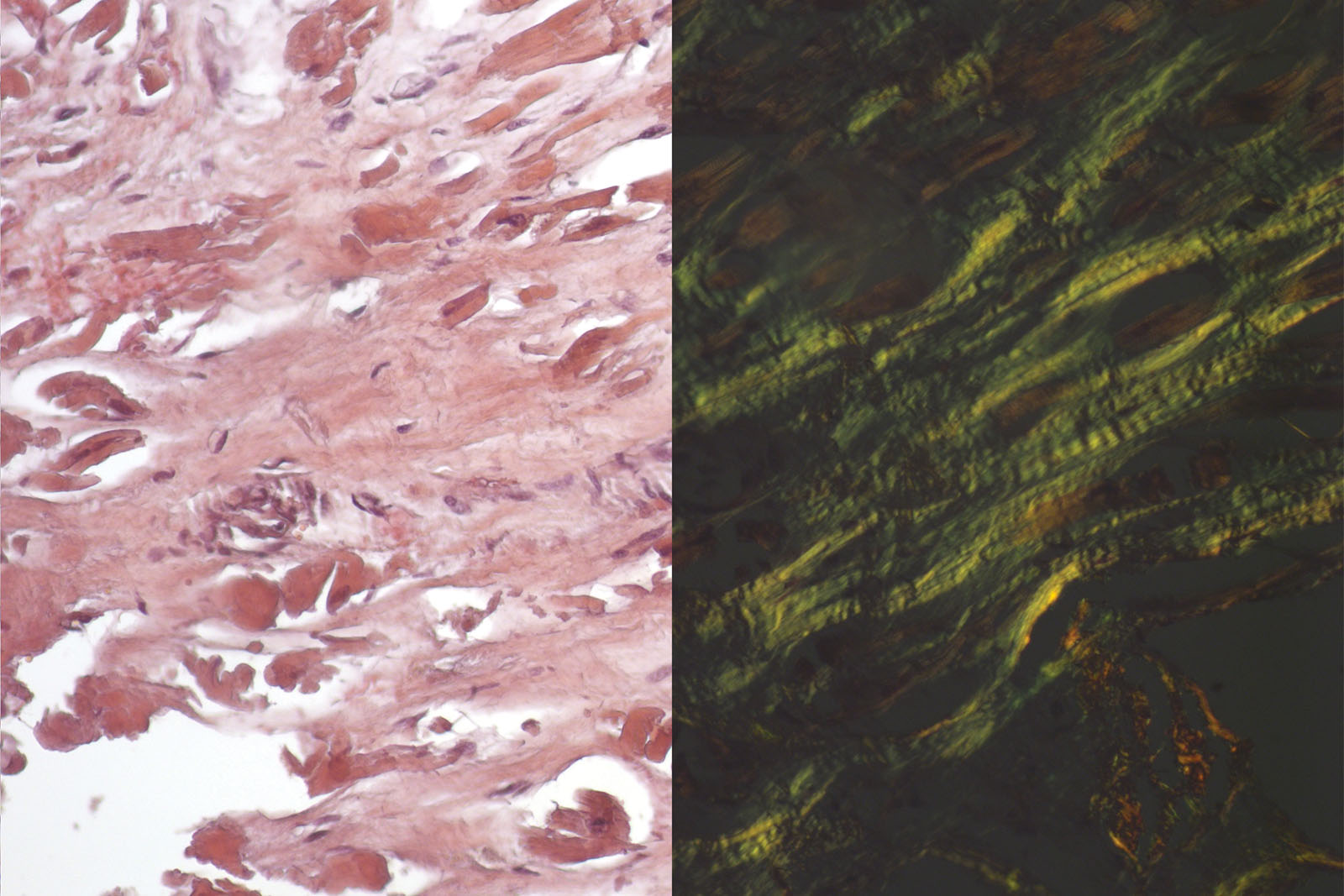 <p>Tissue with amyloidosis or heart tissue </p>