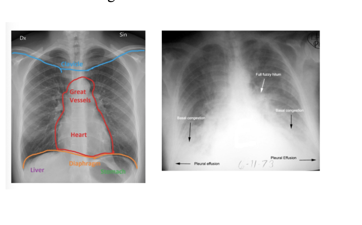 <p>Blood test, and X-ray of the chest </p><ul><li><p>Normal lungs: dark (air-filled)</p></li></ul><ul><li><p>Edema: white (fluid-filled)</p></li></ul><p></p>