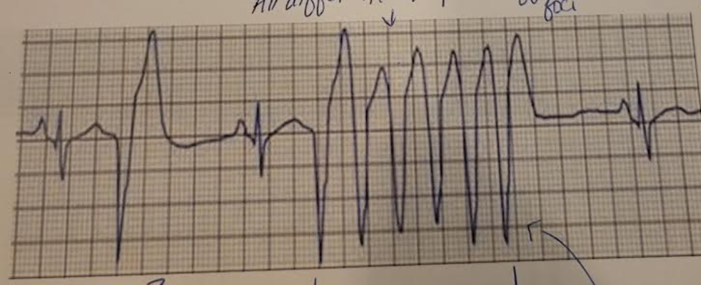 <p>howd you know this had a run of ventricular tachycardia</p>